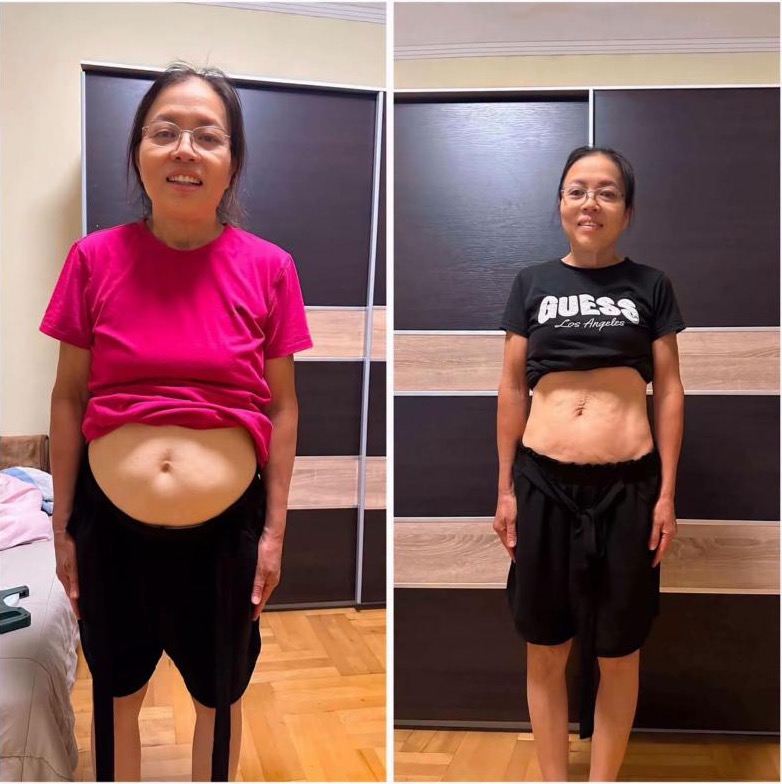 Chị Thái Thị Hà, U70, Hungary – trước và sau khoảng 2 tháng